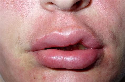 allergic reaction that makes lips swelling fall